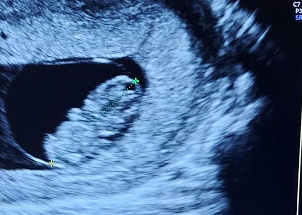 В России запустят реестр беременных женщин